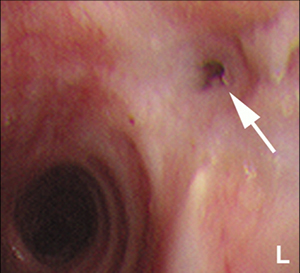 Airway Stent