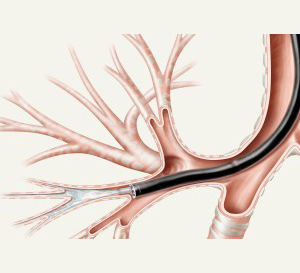 Bronchoscope