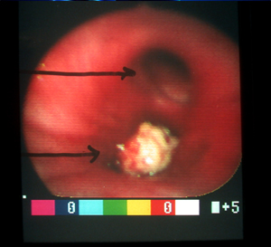 Bronchoscope